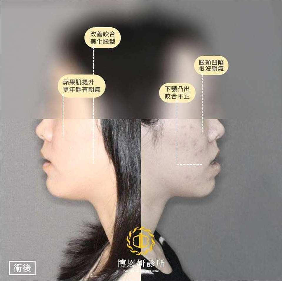 正顎手術不後悔,正顎手術重拾自信,正顎手術,戽斗,許修銨醫師,博恩妍